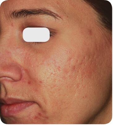 Masked baseline image from a manufacturer acne scar case report
