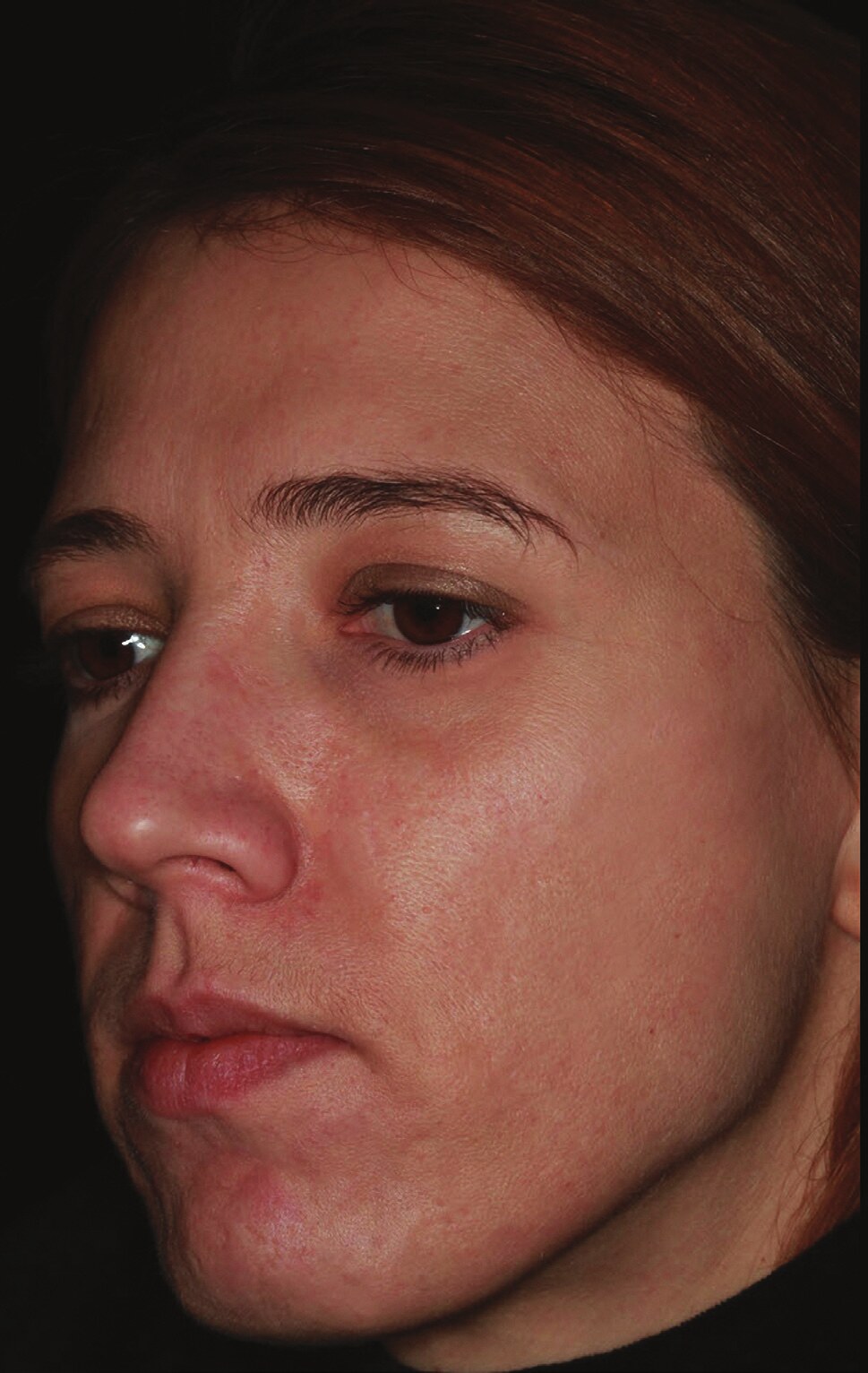 Same Lumenis AcuPulse acne scar case six months after one fractional CO2 treatment