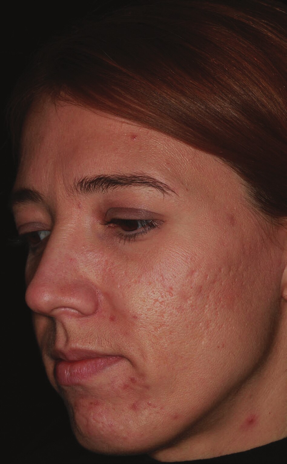 Close-up of facial acne scarring