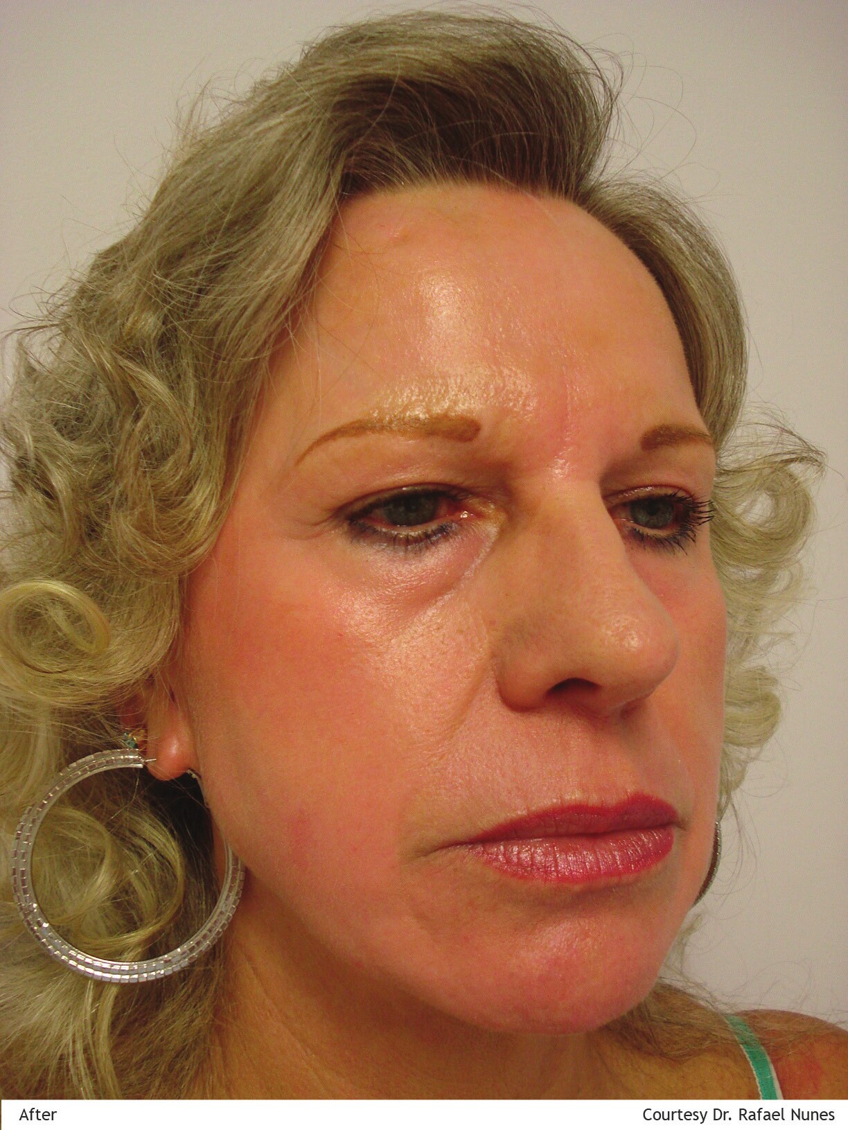 Same Lumenis AcuPulse skin resurfacing case three months after one treatment