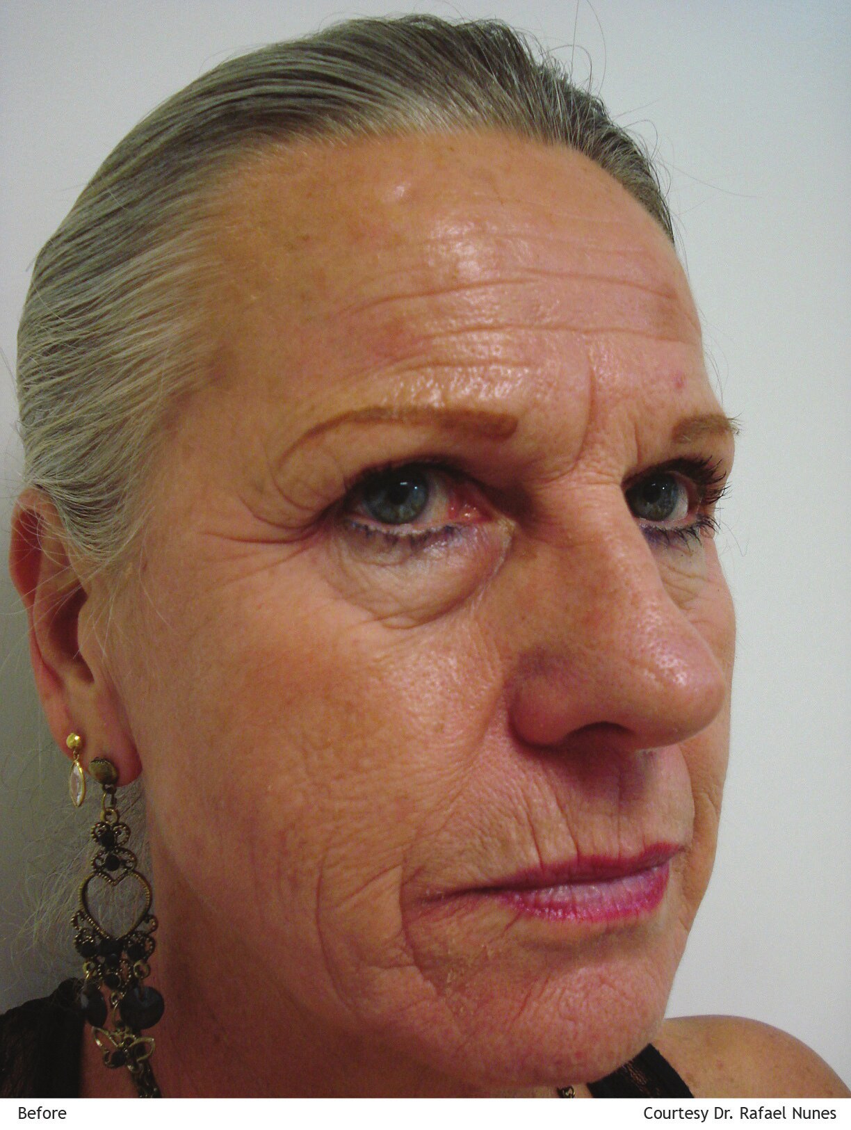 Lumenis AcuPulse skin resurfacing case before treatment