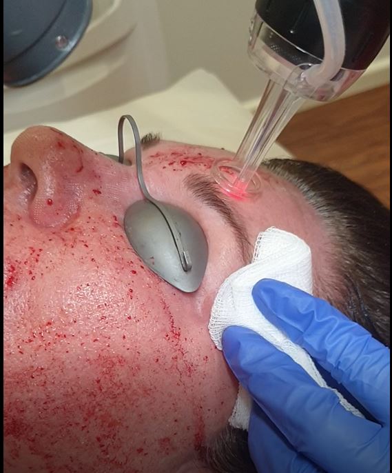 Fractional CO2 laser resurfacing being performed with protective eye shields