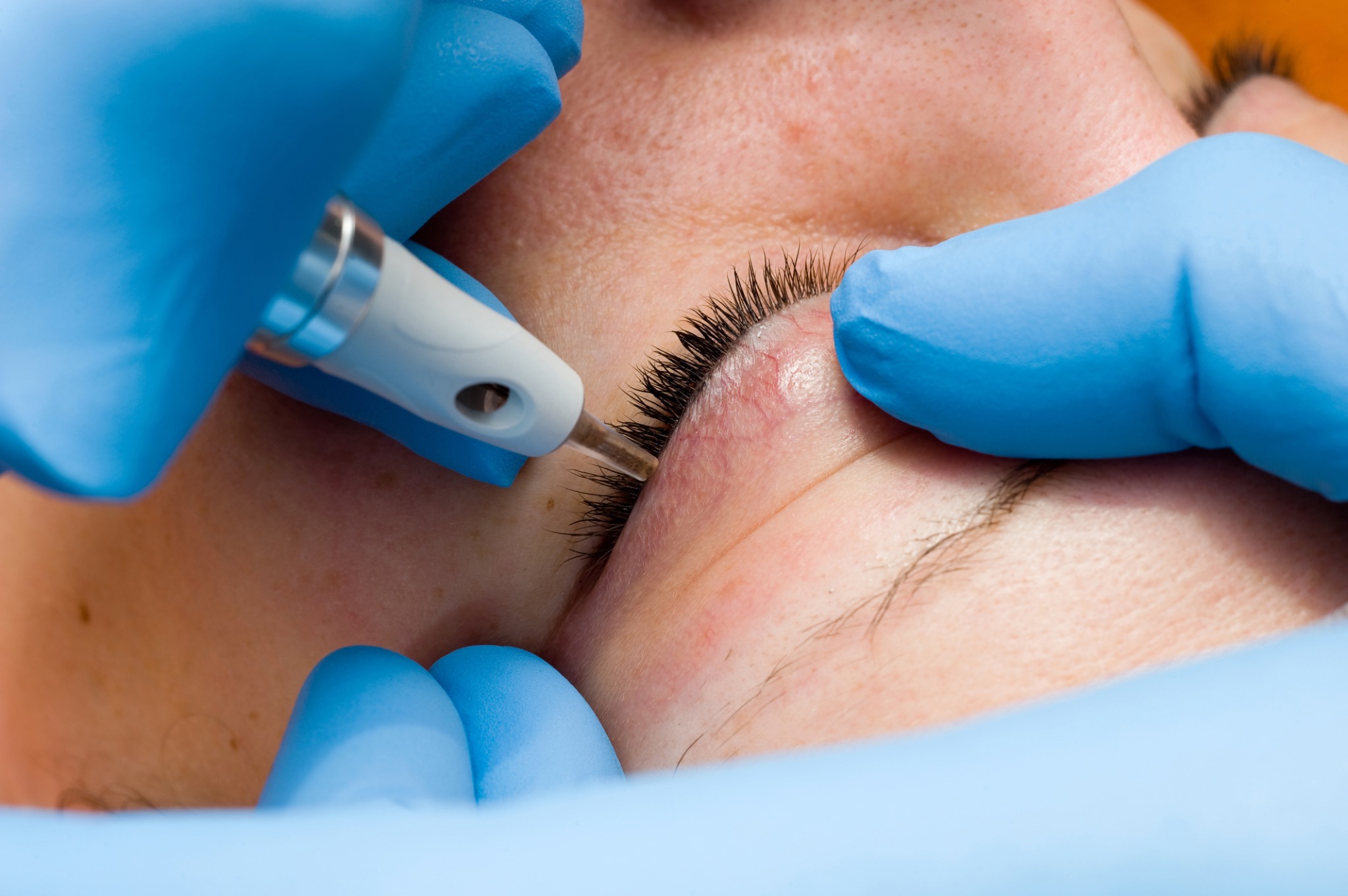 Close-up cosmetic eyeliner tattoo treatment