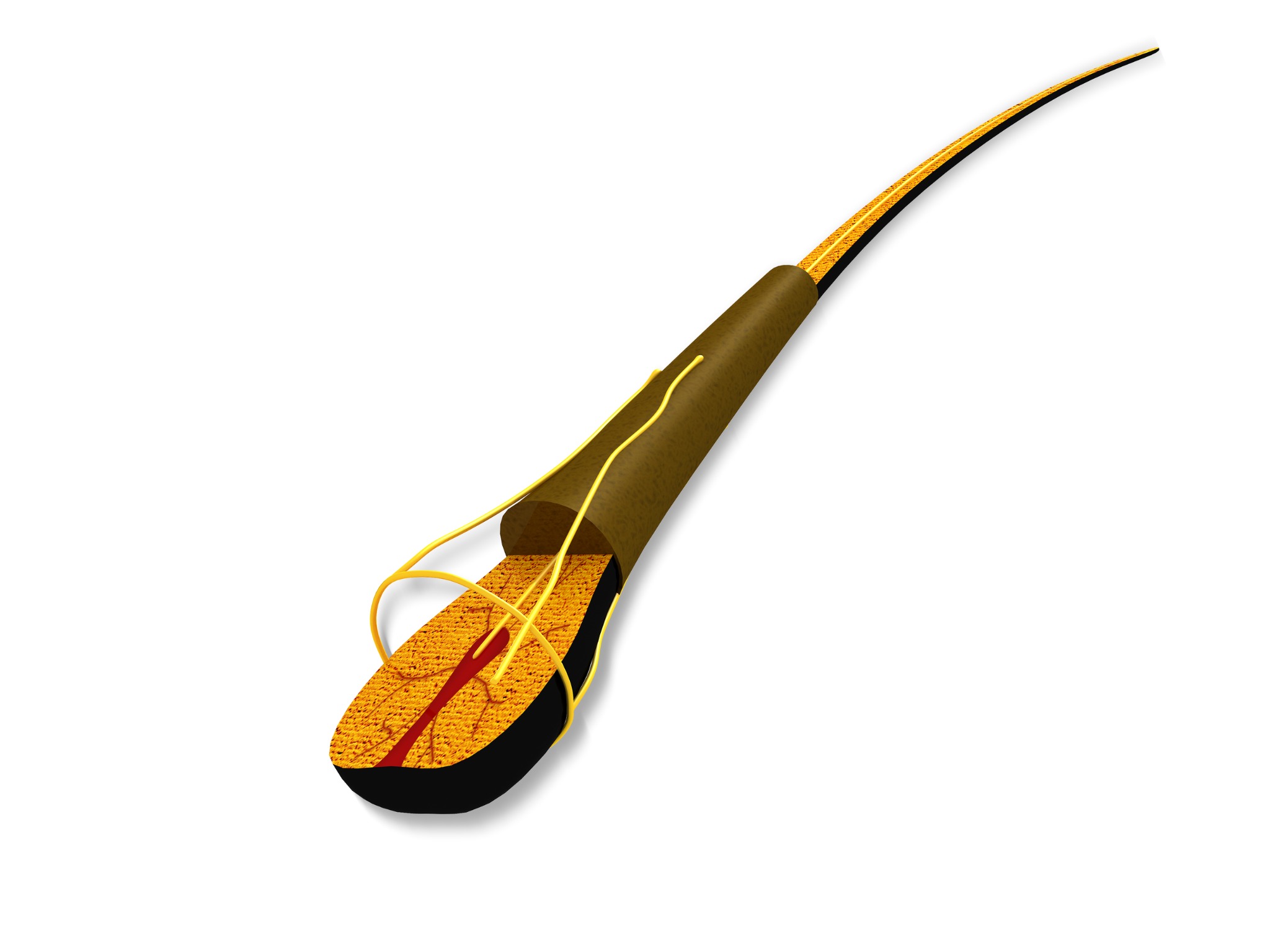 Illustration of a hair follicle treated with electrolysis