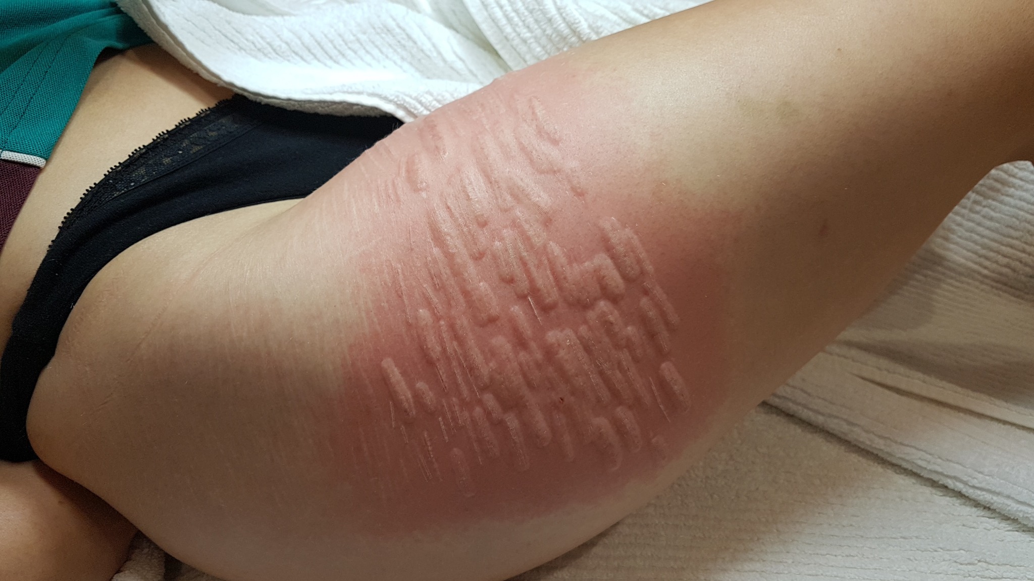 Close-up of stretch marks on the skin