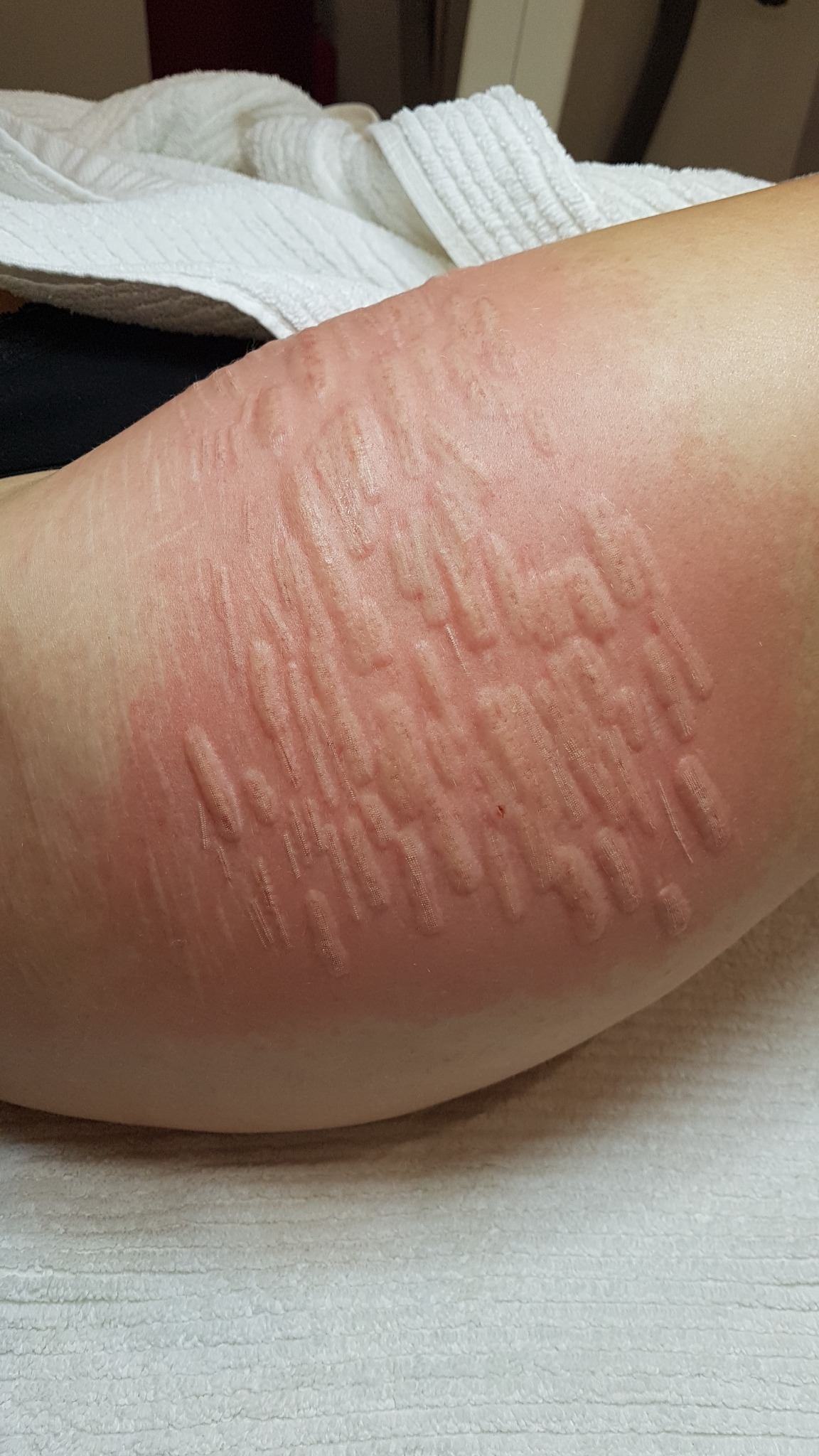 Close view of an immediate fractional laser skin response