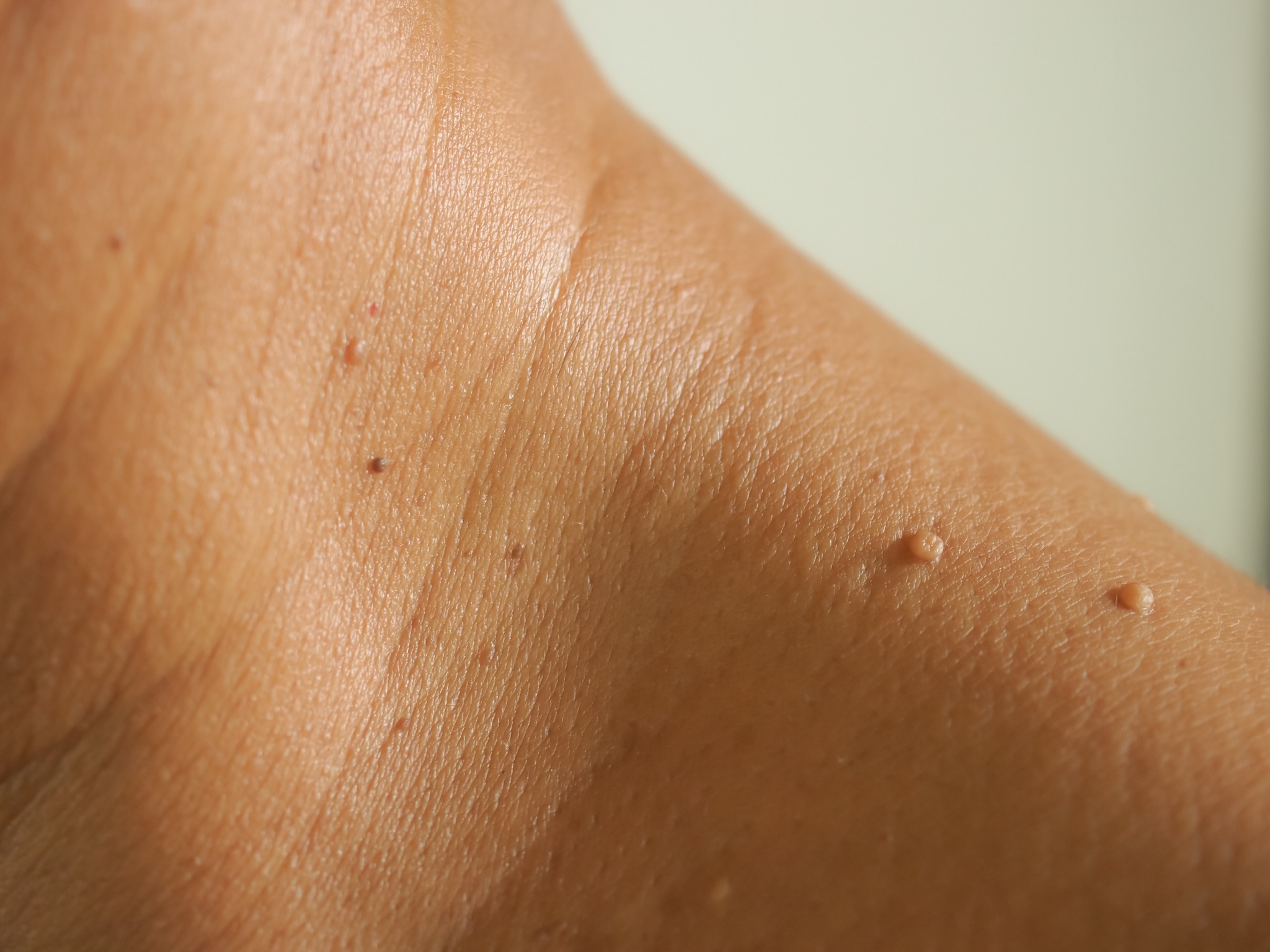 Close-up of several small skin tags on the neck