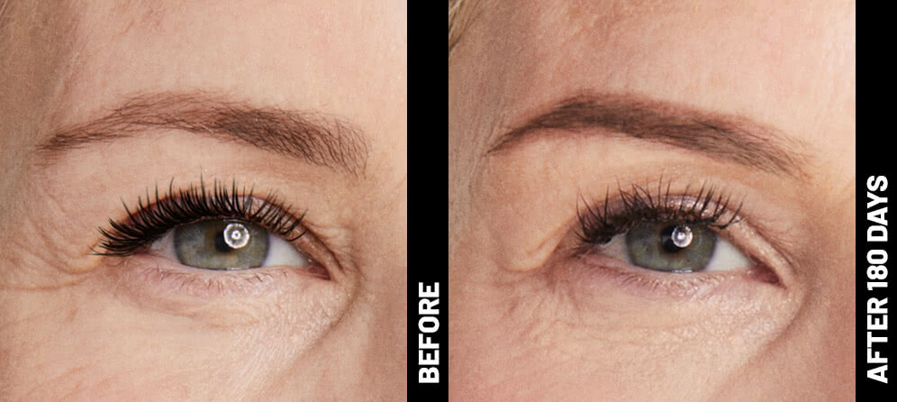 Ultherapy patient brow before treatment and 180 days after treatment