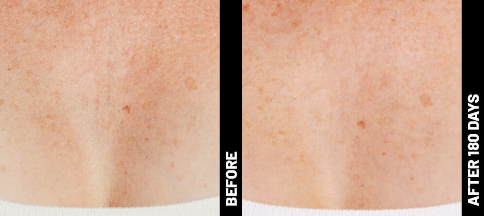 Ultherapy patient décolletage before treatment and 180 days after treatment