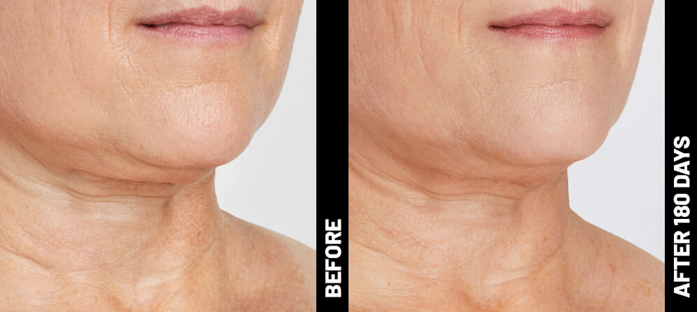 Ultherapy patient neck before treatment and 180 days after treatment