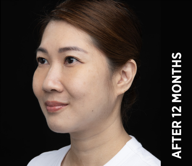 Same Ultherapy manufacturer case twelve months after treatment