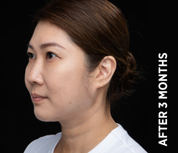 Same Ultherapy manufacturer case three months after treatment