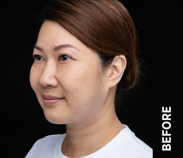 Ultherapy manufacturer case photograph before treatment