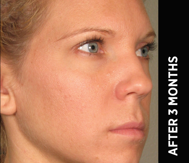 Same Ultherapy manufacturer case three months after treatment