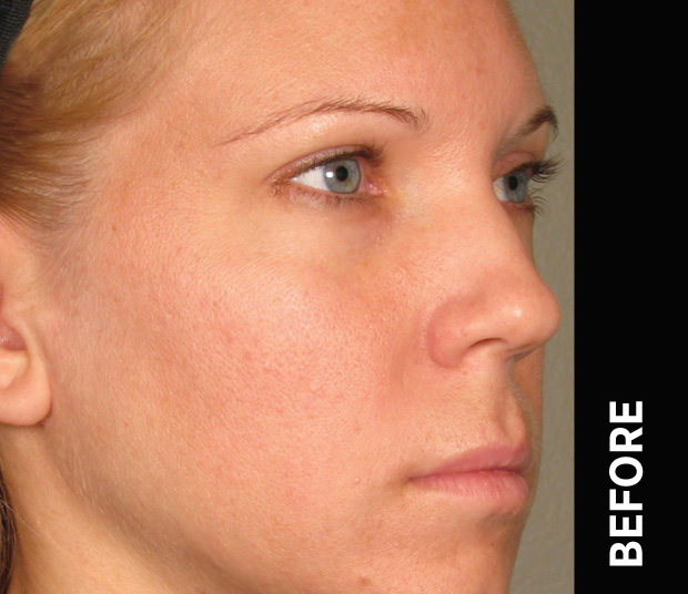 Ultherapy manufacturer case photograph before treatment