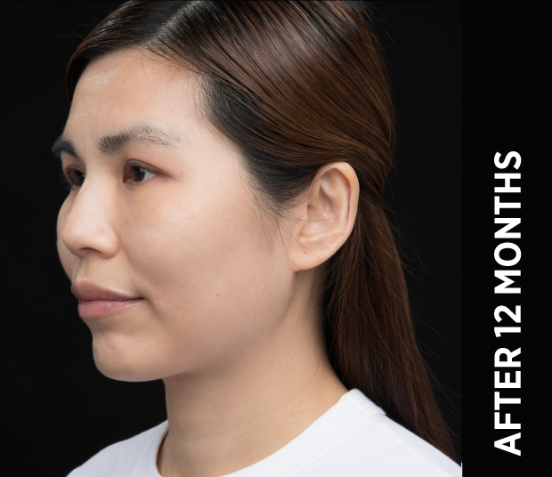 Same Ultherapy manufacturer case twelve months after treatment