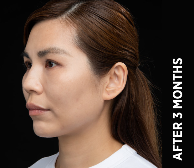 Same Ultherapy manufacturer case three months after treatment