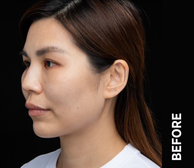 Ultherapy manufacturer case photograph before treatment