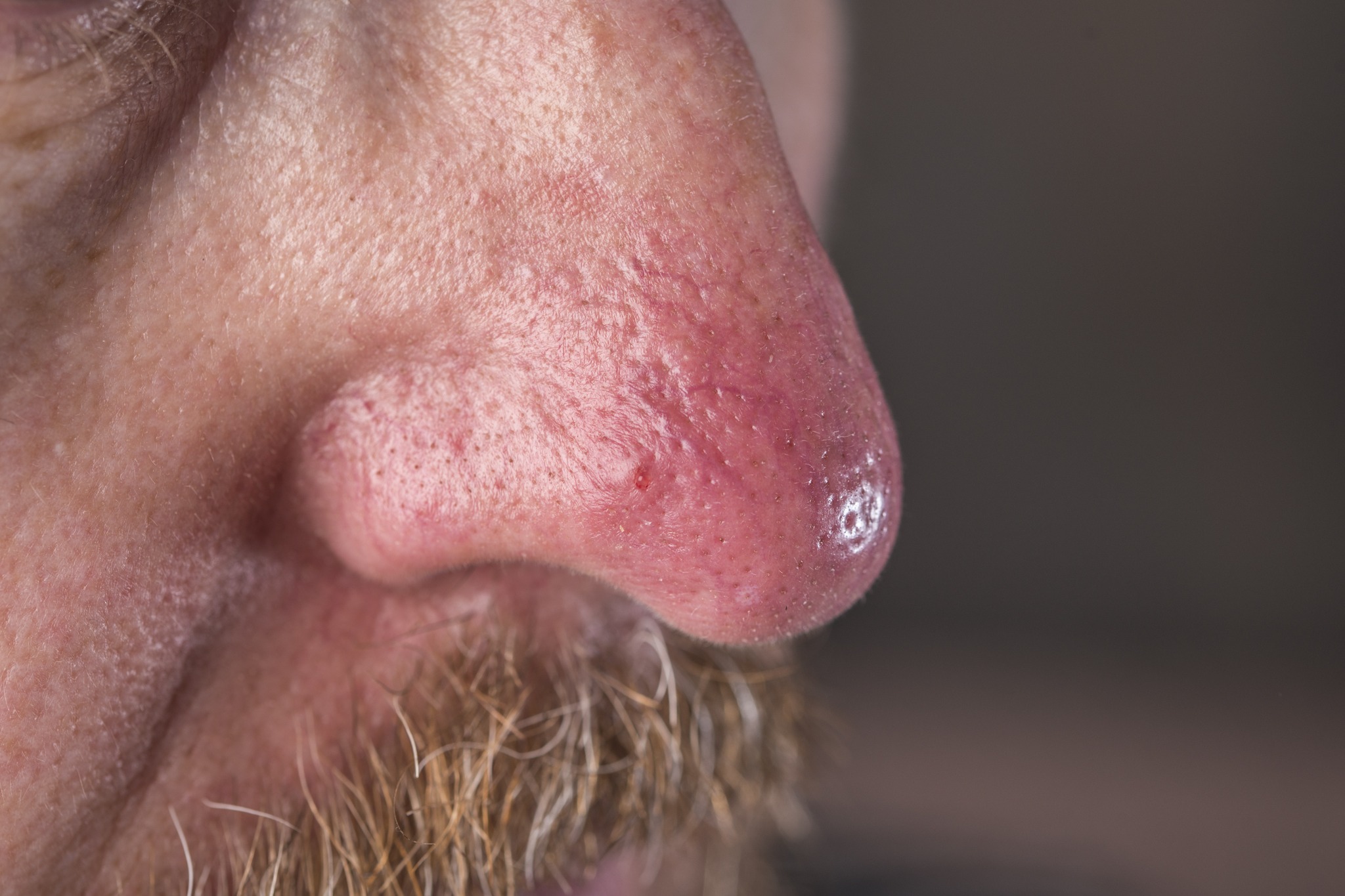 Close-up of visible facial capillaries around the nose