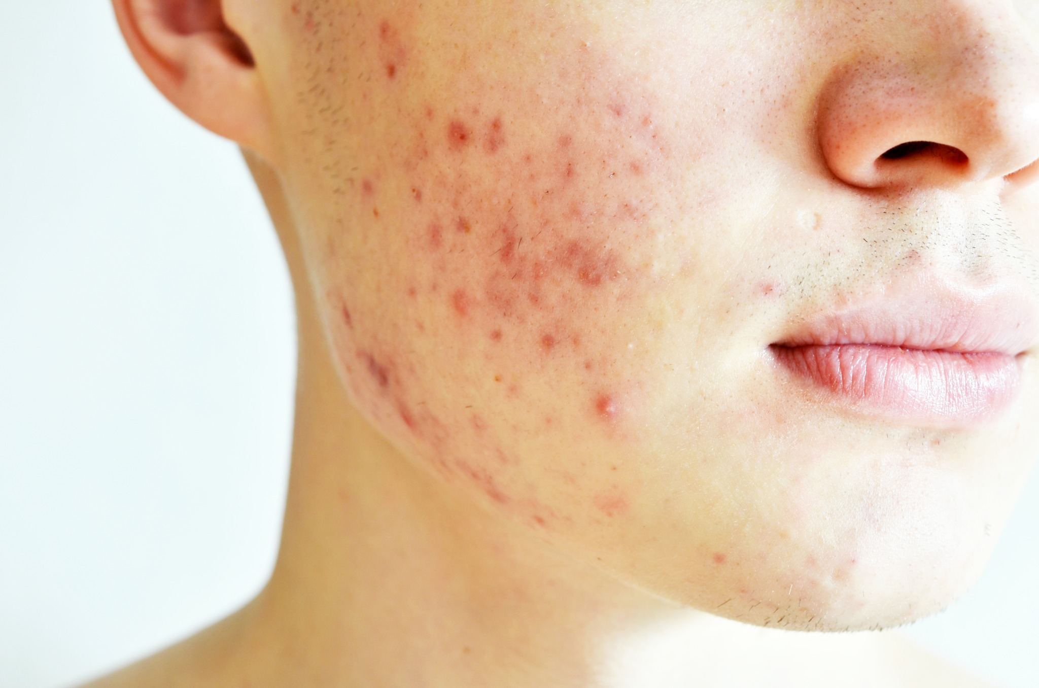 Close-up of active facial acne and congestion