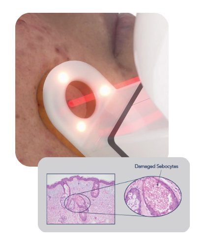 AviClear handpiece on the skin with a magnified view of treated sebaceous glands