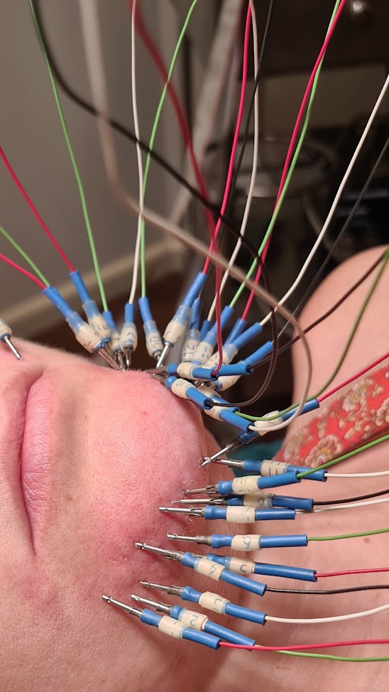 Close-up of multi-needle electrolysis treatment at Advanced Body Image in Darwin