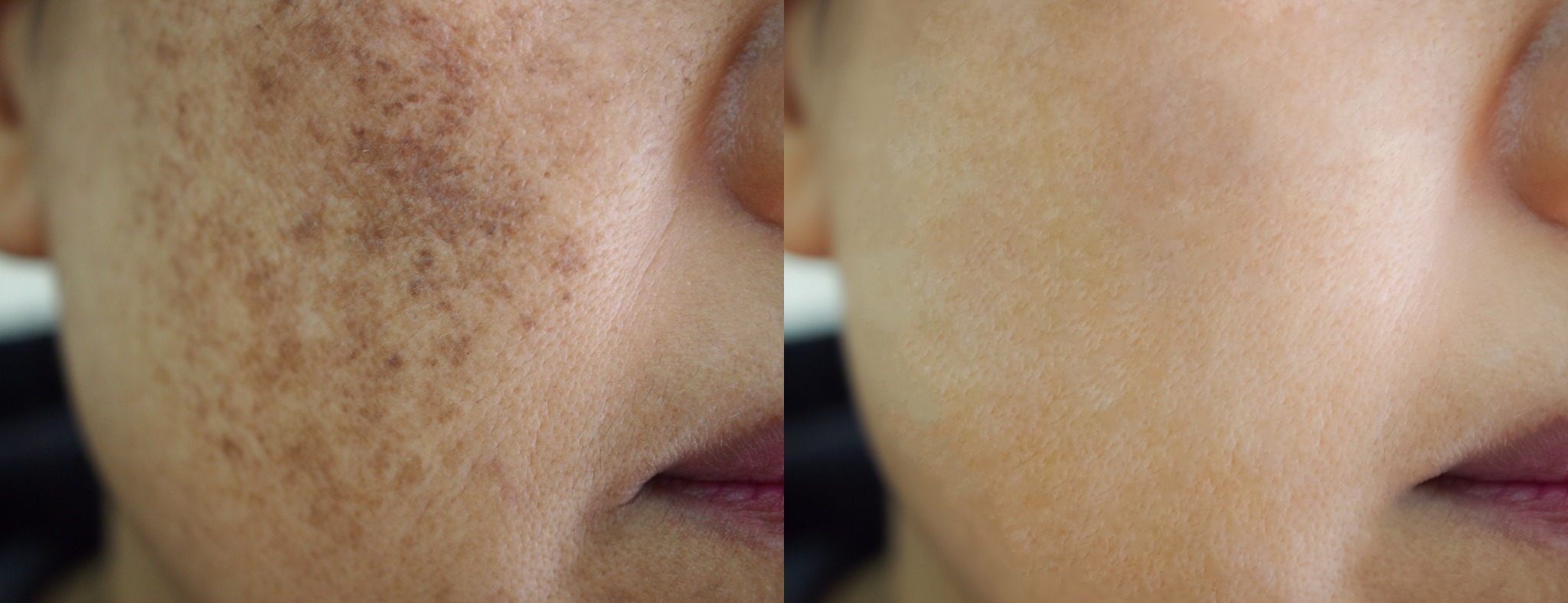 Close-up comparison of facial pigmentation and sun damage