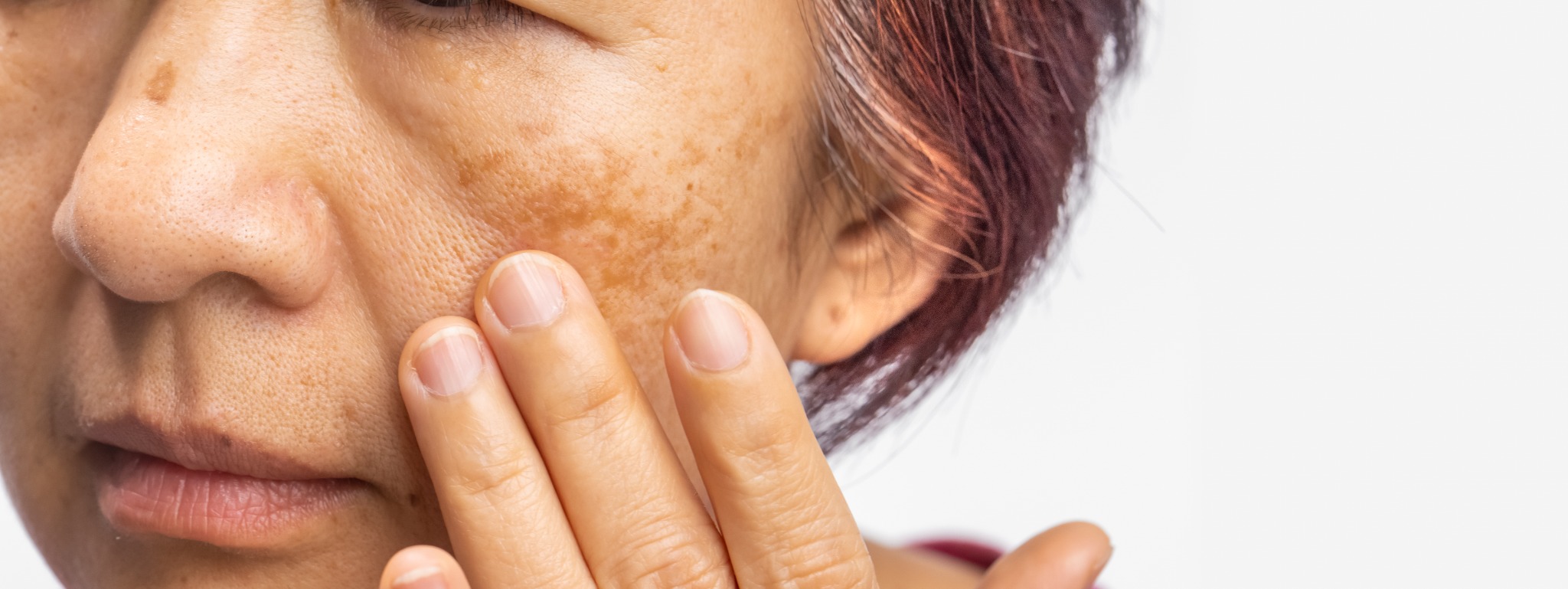 Woman touching visible melasma on her cheek