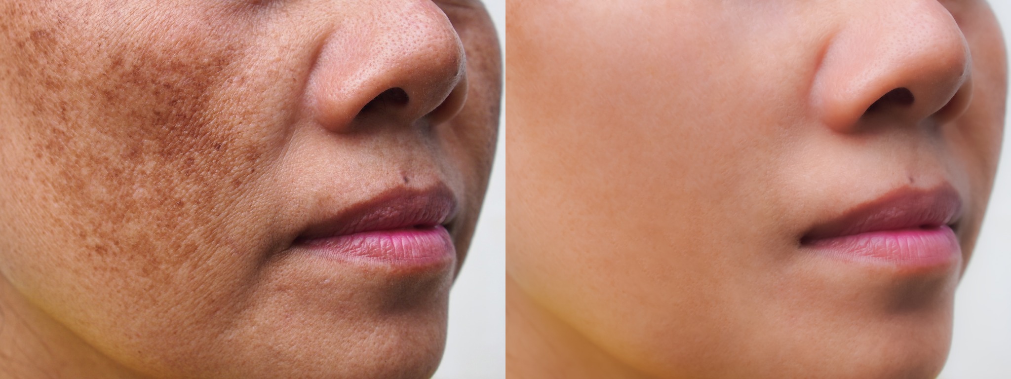 Close-up comparison of visible facial redness